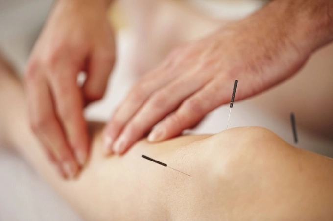 Acupunctuur bij pijnbestrijding 