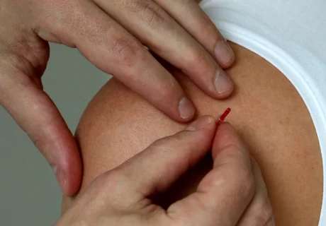 Waarom acupunctuur